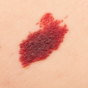 There is new hope for melanoma sufferers. 