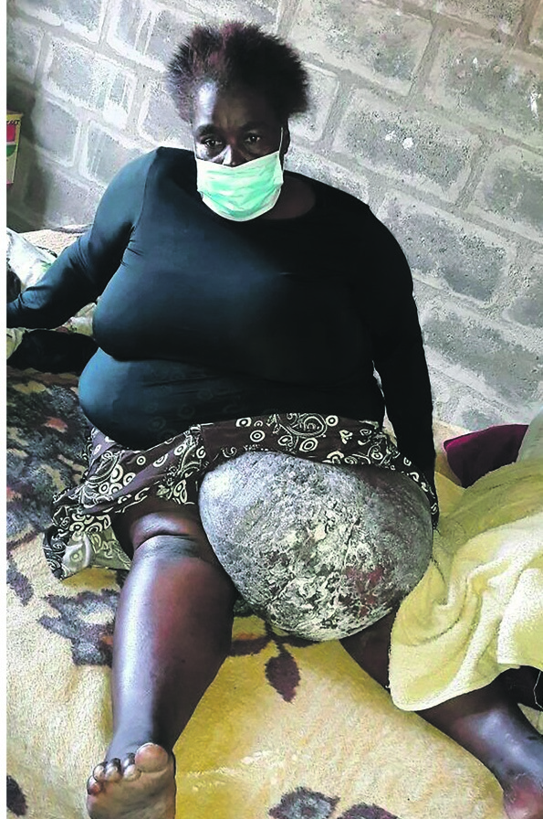 Fikile Ntuli, whose leg has a 25kg growth, needs help to have it removed.