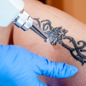 Increasing numbers of people are having their tattoos removed. (iStock)