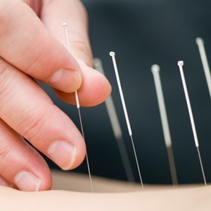 Acupuncture has gained popularity as an alternative treatment. (iStock)