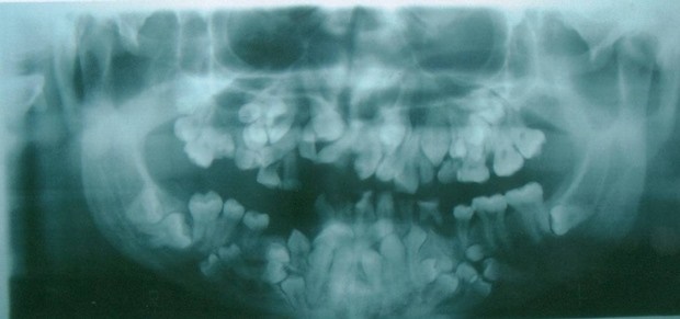 CCD Cleidocranial Dysplasia supernumerary teeth hy