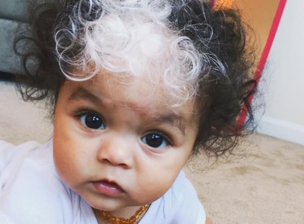 Baby girl born with birthmark that makes a streak of her hair snow white –  just like her mom | You