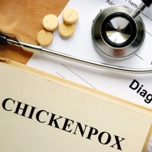 Chickenpox from Shutterstock
