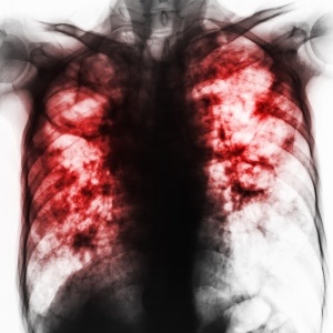 Tuberculosis is HIV's 'terrible twin'.