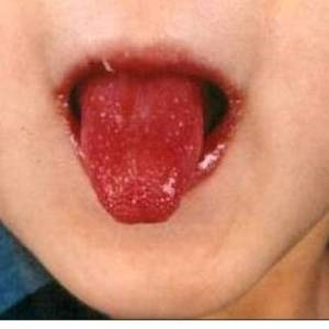 Those with Kawasaki disease often have an inflamed, red tongue known as "strawberry tongue".