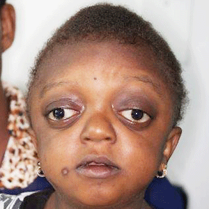 Akikere, a six-year-old from Nigeria, suffers from Crouzon syndrome, a genetic disorder characterized by the premature fusion of the skull bones and cranial base. Image supplied.