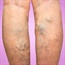 Shorter people may duck risk of varicose veins