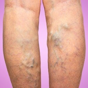 Height is related to increased risk of varicose veins. 