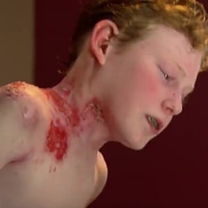 Jonathan Pitre, a 14 year old living with EB. 
