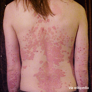 Psoriasis on the back of a females back