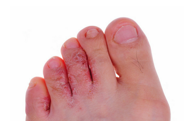 swimmers itch feet