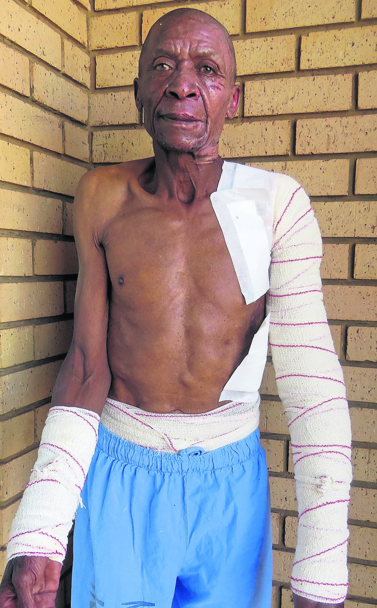 Ben Maphanga was scalded with boiling water.        Photo by                 Ntebatse Masipa 