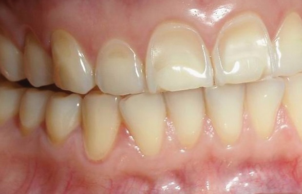 dental erosion, teeth, sensitivity
