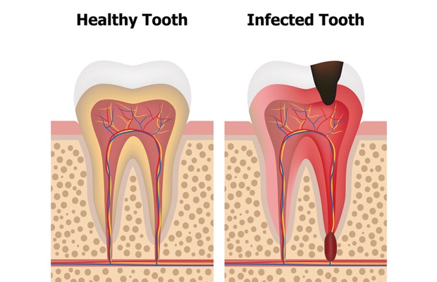 nerve, tooth, illustration