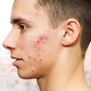 There may be many causes of acne. 