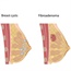 Fibroadenoma of the breast