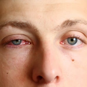 A woman was sent to the ER after experiencing severe eye pain and swelling for more than five days.