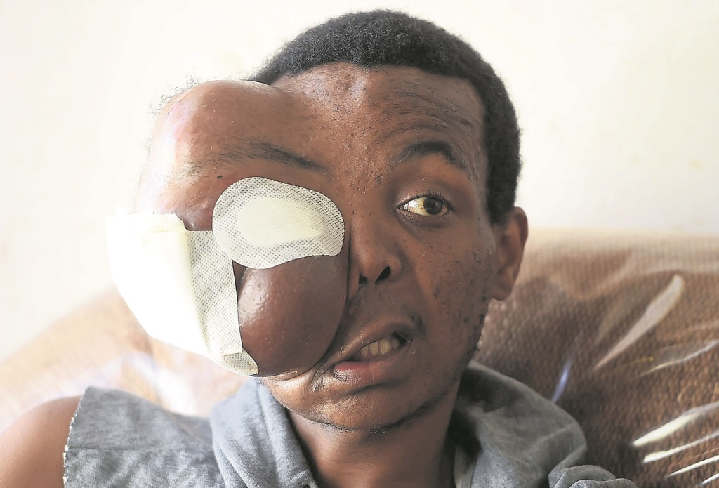 Bongani Mashao says doctors keep postponing the surgery to remove his growth.   Photo by Trevor Kunene