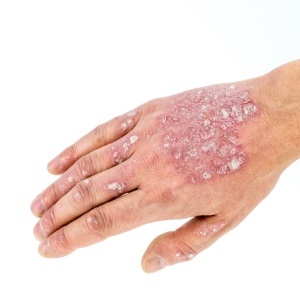 A significant percentage of the world's population suffers from psoriasis. 