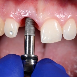 Tooth implants aren't always the best solution. 