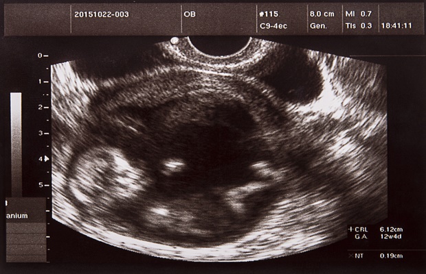 ultrasound scan photo 