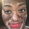 ‘It was like it happened overnight’ – Bride-to-be develops vitiligo months before her wedding