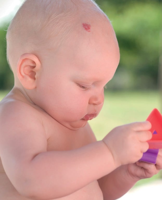 What Birthmarks Really Mean Parent