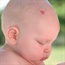What birthmarks really mean