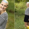 Teen with alopecia takes incredible photos to raise awareness