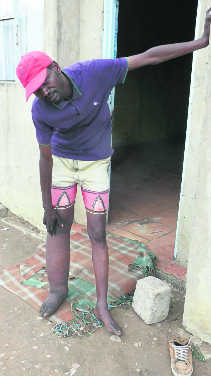 Mcebo Mthembu needs medical attention so his leg can heal.   Photo by    Bongani             Motaung