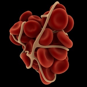 Six signs you might have a blood clot. 