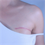 Breast conservation vs mastectomy
