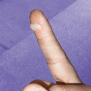Blister on finger - Google Images