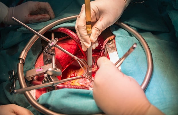 open heart surgery 