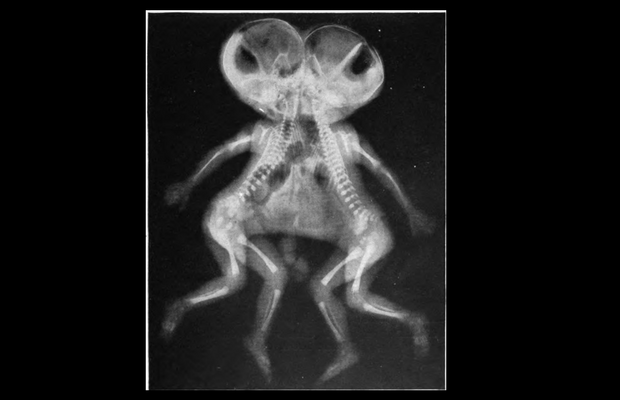 x-ray of conjoined twins 