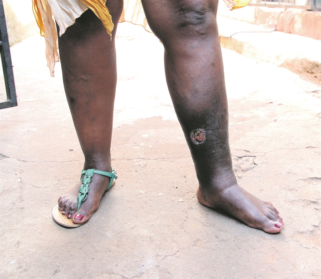 Tholakele Yende says she is stuck at home because her leg is so painful.         Photo by Collen Mashaba