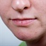 Lifestyle choices can reduce severity of rosacea