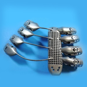 This image shows the front of 3-D printed titanium sternum and ribs 