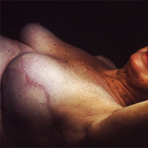 Side view of face of a woman's body indicating breast reconstruction post mastectomy. Nipple missing, and cicatrix (scar) is prominent. Photo by Linda Bartlett for National Cancer Institute UK. Wikimedia Commons. 
