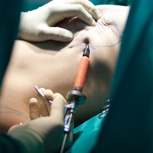 breast reconstructive surgery, using the  'fat pad' method 