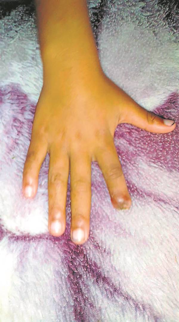 This is how the six-year-old girl’s hand looks after her finger was chopped off, allegedly at school. 