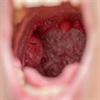 WATCH: What happens when your tonsils are removed?