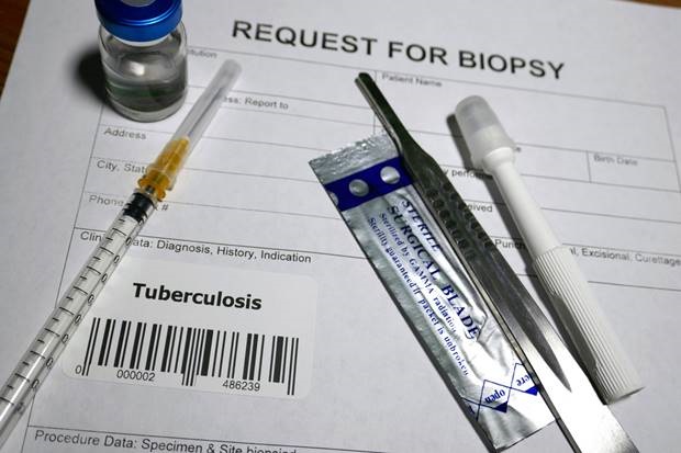 TB testing kit. Picture: iStock
