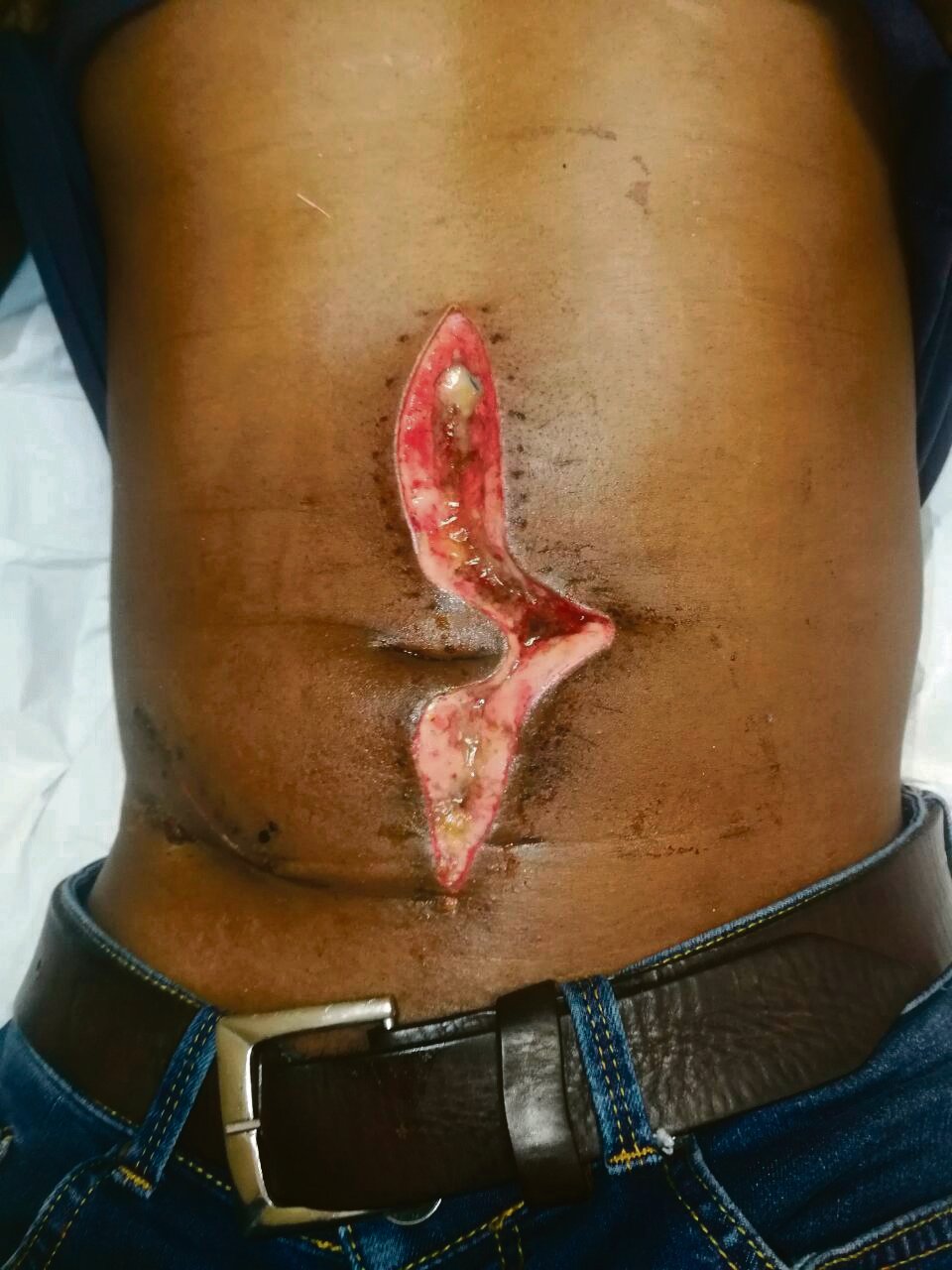 Mcebiseni Nxumalo’s stomach has looked like this for close to a month.                  Photo by Msamariya Diza