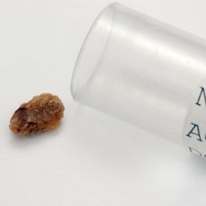 Passing kidney stones can be a very painful experience. 