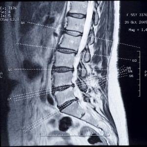 lumbar spine xray