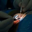 Cutting edge of cataract surgery