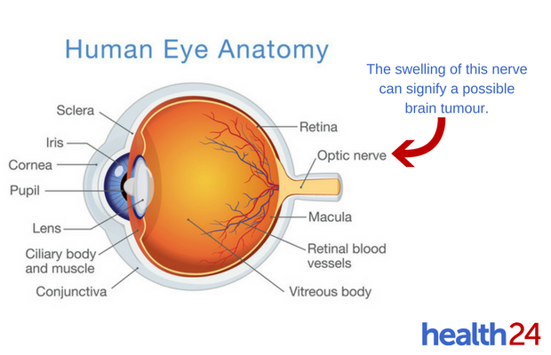 optic nerve swelling