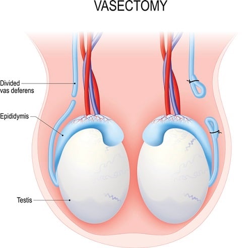 What is it like getting a vasectomy? 