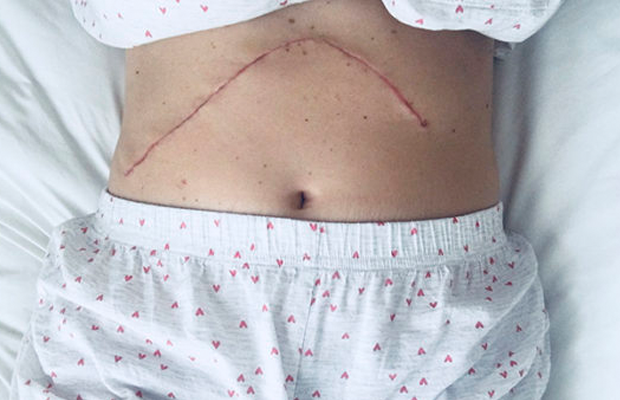 Michelle Mardon's scar after surgery
